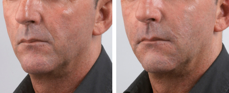 hyamarkt-ultra-deep- hyamarkt ultra deep